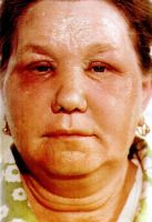 Медикаментозный дерматит кожи вокруг глаз