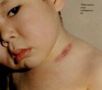 туберкулёз кожи на шее у ребенка
