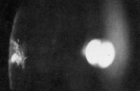 Наблюдение, аналогичное представленному на фото 6. При щелевом освещении видно помутнение в области задней капсулы.