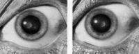 Задняя полярная катаракта (стереофото).