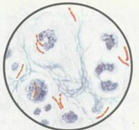 Микобактерия туберкулеза — окраска препарата по Цилю—Нильсену