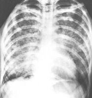 фото рентгенограммы пневмонии при ветряной оспе