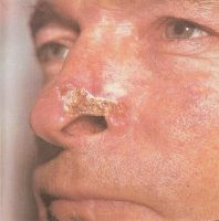 Прободающая форма базалиомы: полностью разрушено крыло носа