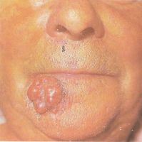 Опухолевая форма базалиомы кожи губы и подбородочной области