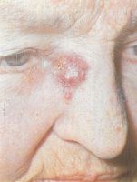 Ботриомикома (пиогенная гранулёма) в области внутреннего угла глаза. Иногда можно спутать с узелковой базалиомой