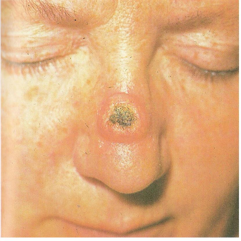 кератоакантома спинки носа