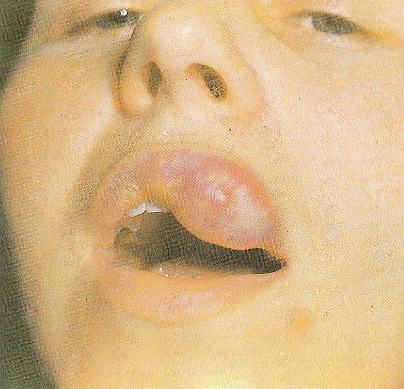 кавернозная гемангиома верхней губы (до лечения)