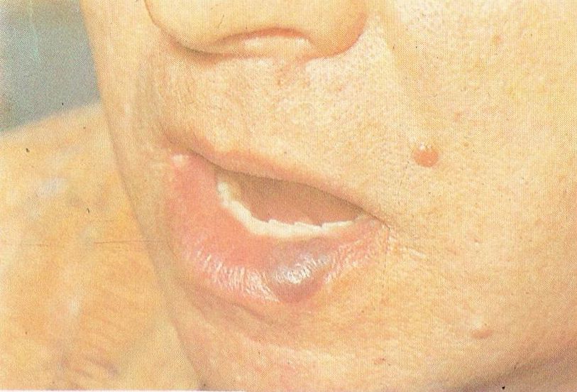 кавернозная гемангиома нижней губы