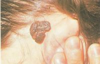 Наличие черного невуса на коже возле волосистой части головы