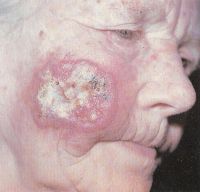 Язвенная форма плоскоклеточного рака кожи на щечной области 