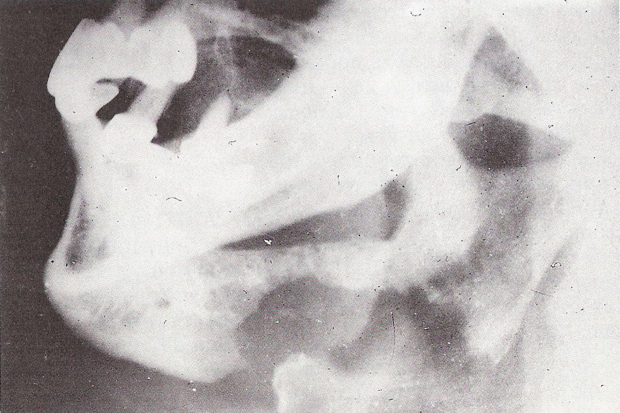 на рентген-снимке видны признаки рака нижней челюсти