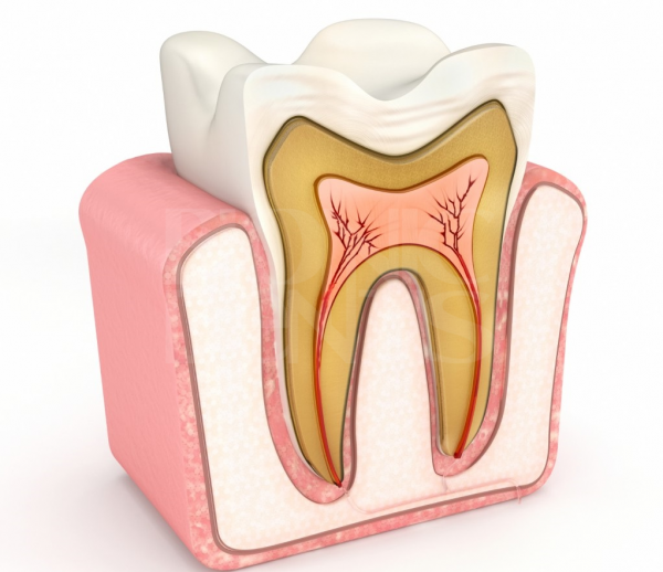 причины возникновения перфорации корня зуба