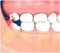 swollen gum around wisdom tooth treatment