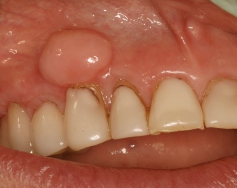 lump on gums pictures 2