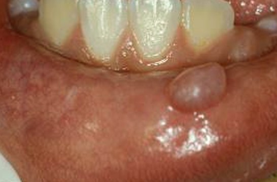 lump on gums pictures