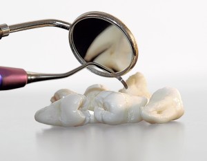 Why Dentists Extract Wisdom Teeth