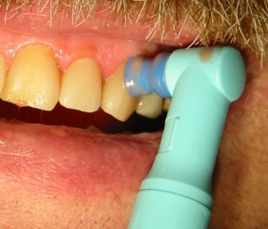 Dental Tooth Polishing - Photo Courtesy of Wsiegmund