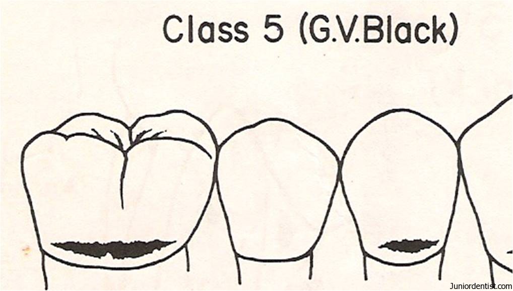 Class V Carious Lesion