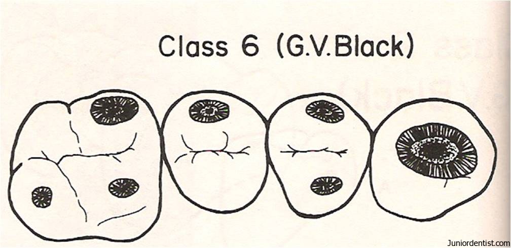 Class VI Carious lesion