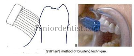 How to Brush - Stillman Brushing technique