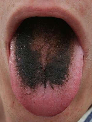 Черный волосатый язык