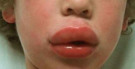 Отек верхней губы из-за аллергии