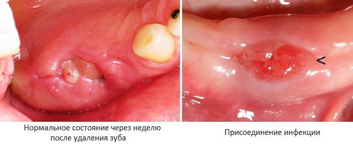 Нормальная и инфицированная шишка после удаления зуба