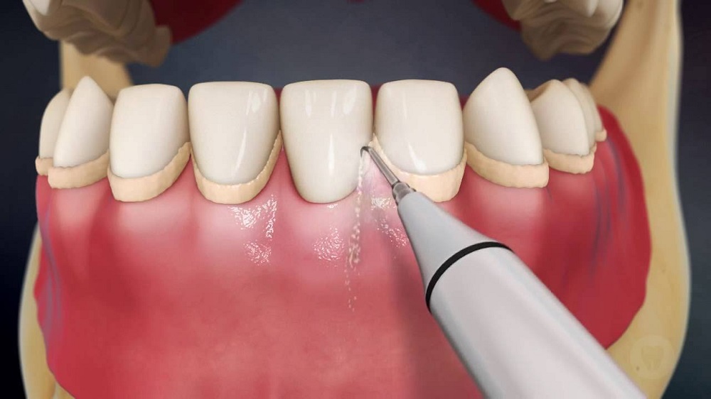 Удаление налета в стоматологии