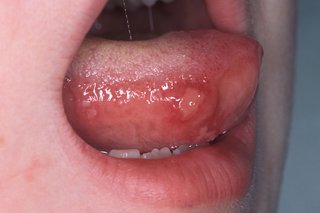 Mouth ulcer on a young child