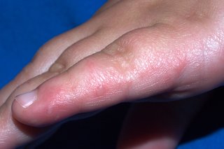 Small blister on young child
