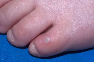 Grey blister on a young child