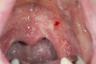 Red patches in mouth caused by oral thrush