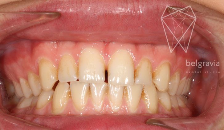 Профессиональная чистка зубов в клинике Belgravia Dental Studio