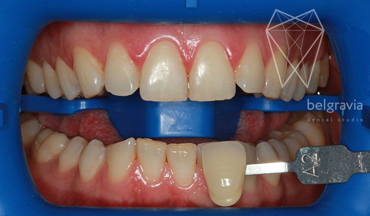 Профессиональная чистка зубов в клинике Belgravia Dental Studio
