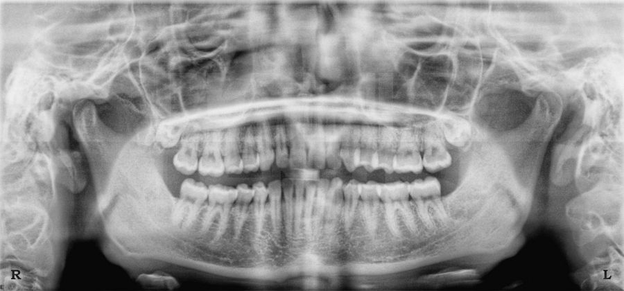 стоматолог Озеров удаление нижнего зуба мудрости