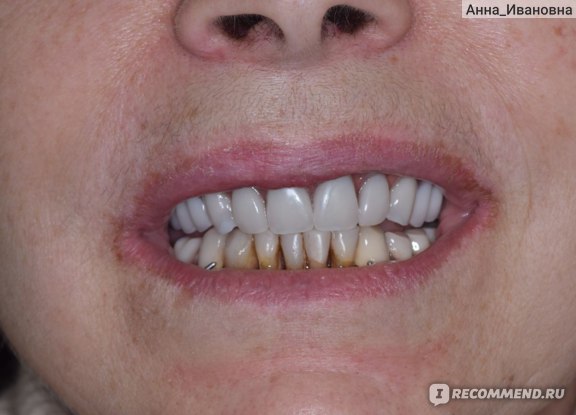 новые зубы на верхней челюсти