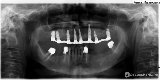 рентгеновский снимок после установки имплантов