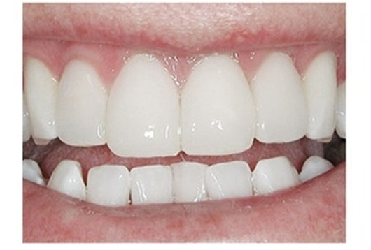 зубы после установки композитных виниров
