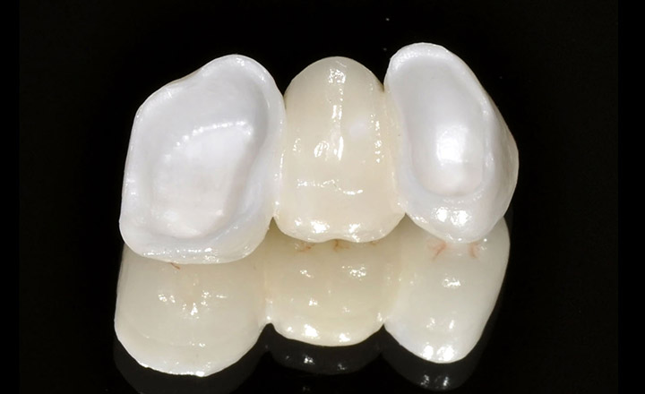 Металлопластиковые коронки на зубы
