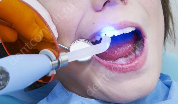 светоотверждаемые пломбы на передних зубах