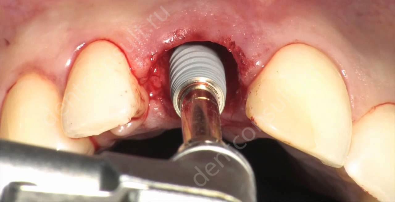 Что лучше – протезирование или имплантация зубов?