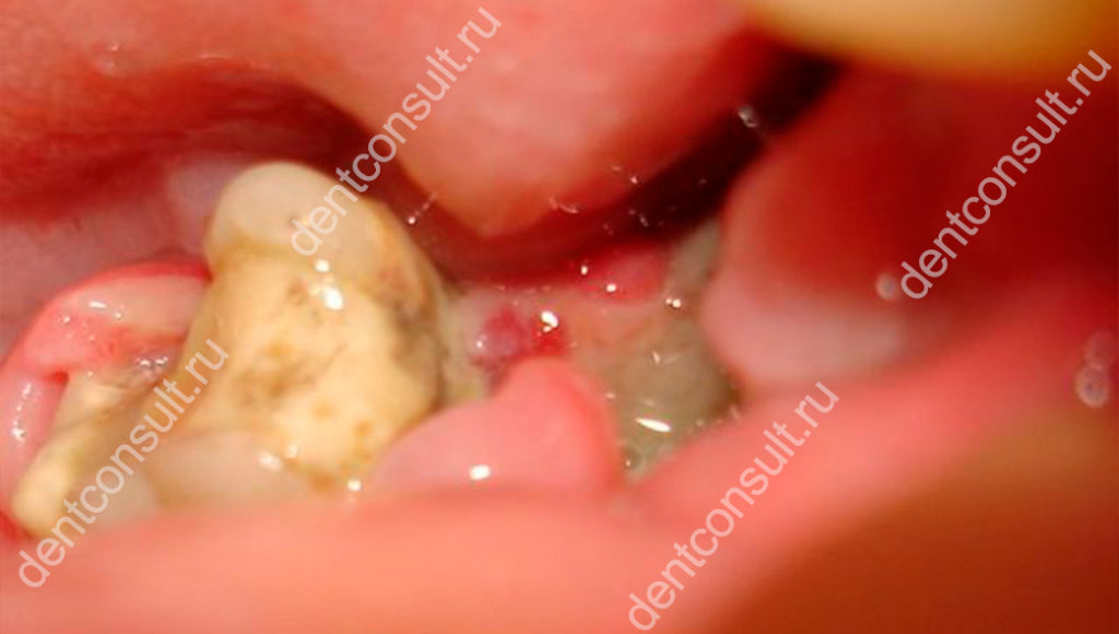 альвеолит после удаления зуба