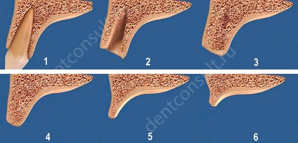 На фото показаны этапы атрофирования костной ткани после удаления зуба