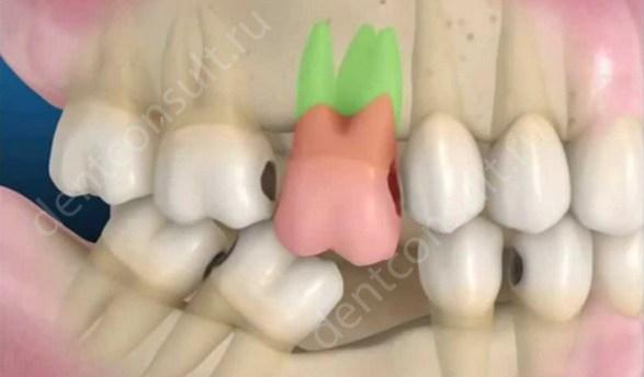 Фото: изменение положения зубов после удаления