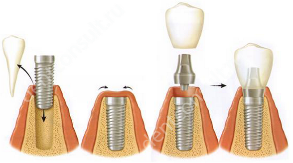 Фото: способ одномоментной имплантации зуба