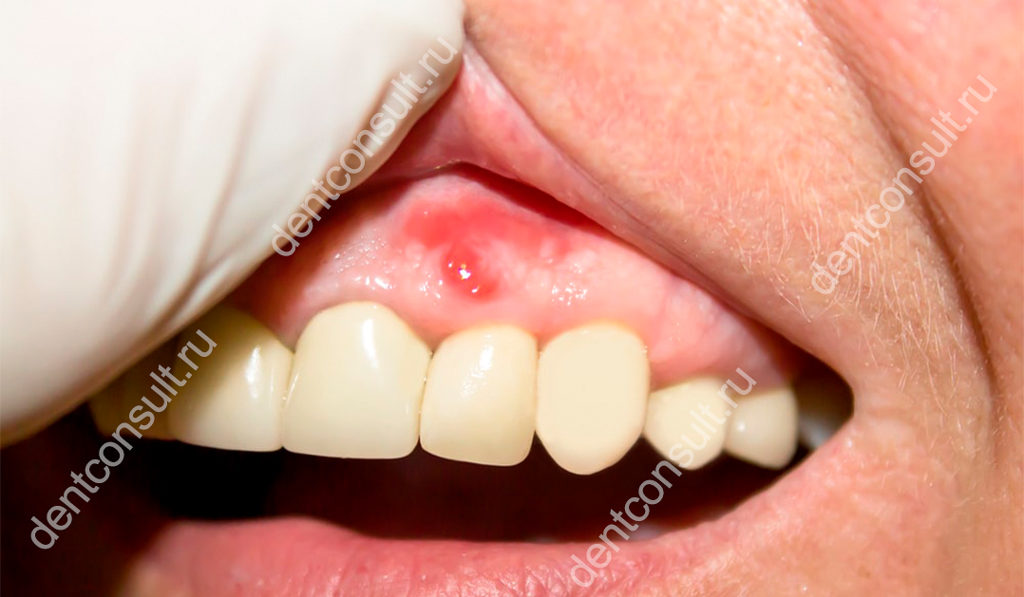 воспаления надкостницы зуба