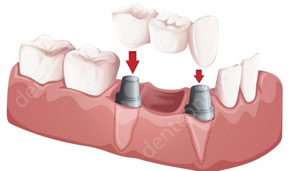 Фото: Восстановление зубов мостовидными протезами на культевых вкладках