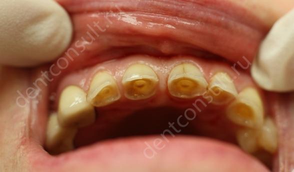 Фото: патологическая стираемость зубов