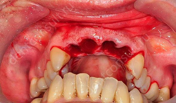 Удаление зубов при проведении протезирования
