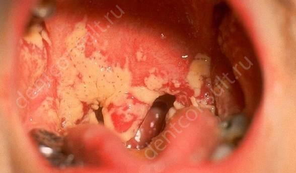 На фото показан катаральный стоматит